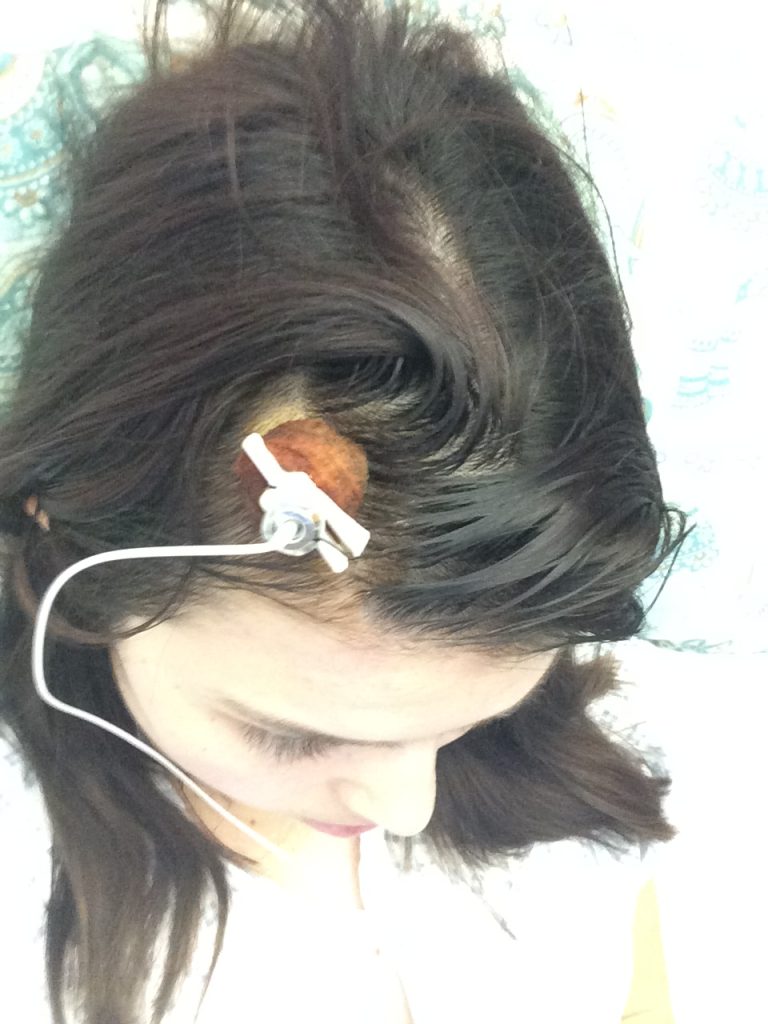 A top view of Jennis head, mainly showing her brown hair. There is a visible piece of medical equipment protruding from her head.