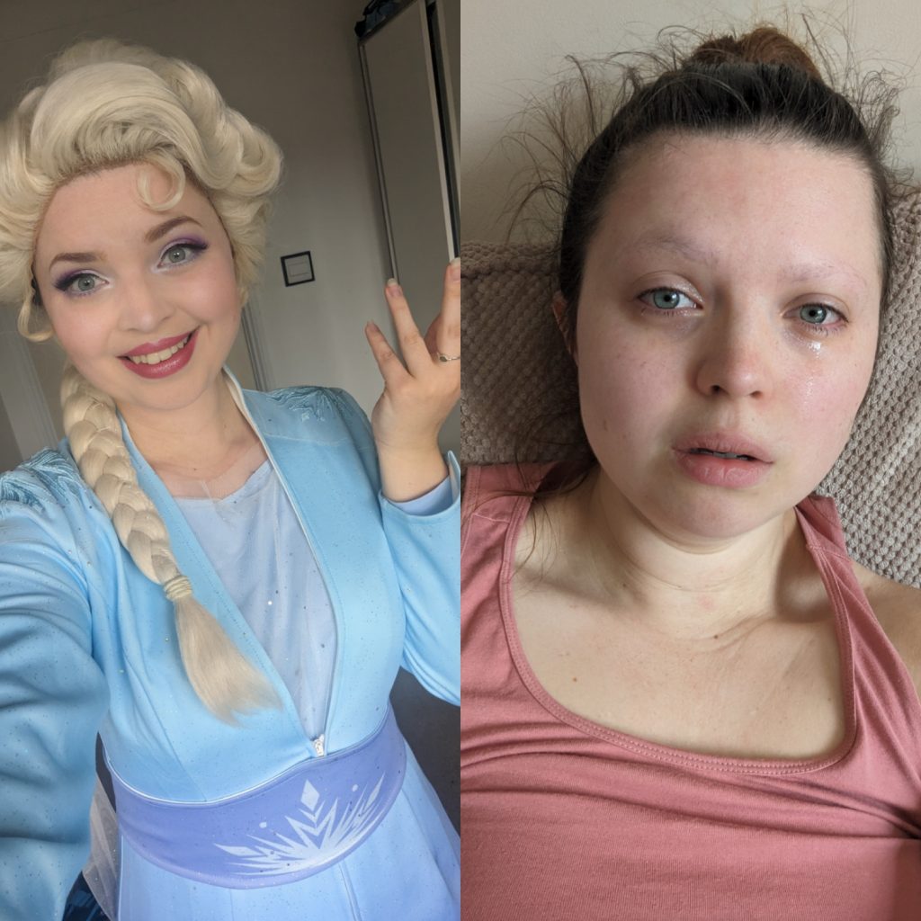 side by side photos of Jenni in one she is dressed as Elsa to perform at a children's party in the other she is teary and has no eyebrows and is laying looking exhausted on the sofa